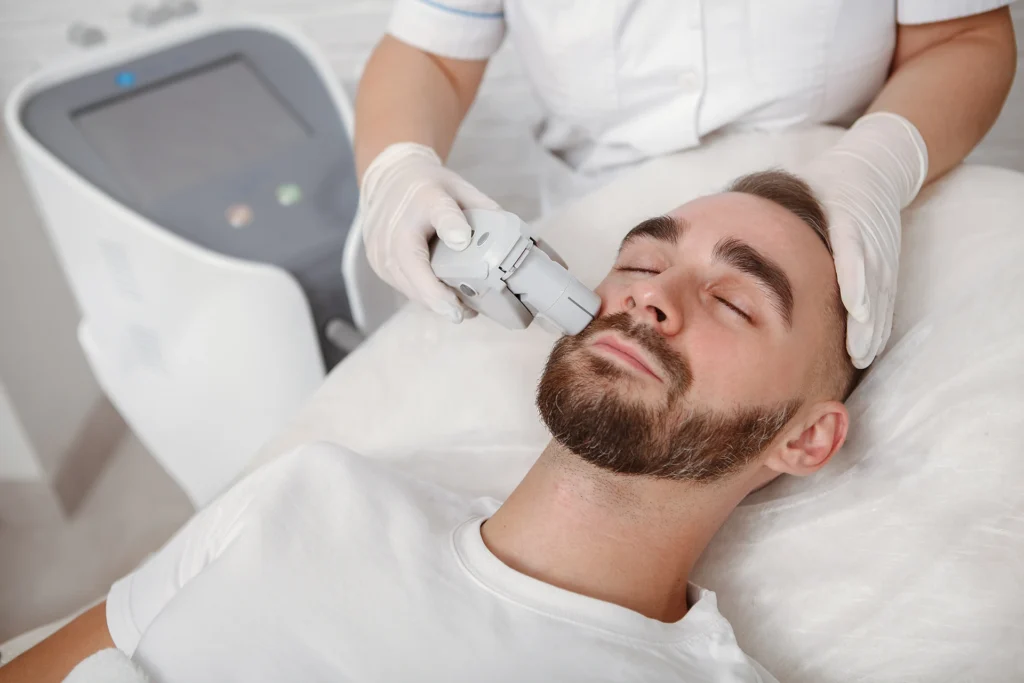 Beard Laser Hair Removal
